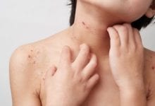 Photo of علاج حساسية الجلد عند الأطفال