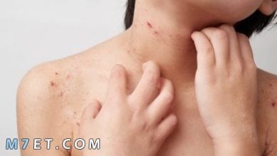 Photo of علاج حساسية الجلد عند الأطفال