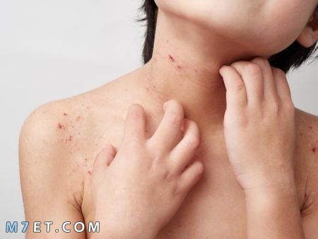 علاج حساسية الجلد عند الأطفال موقع م حيط