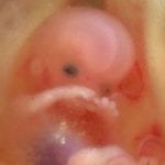 متى ينزل الجنين بعد الإجهاض وما هو الفرق بين دم الإجهاض ودم الحيض
