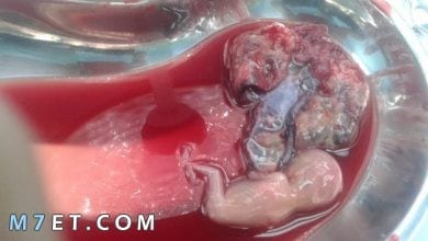 Photo of أعراض الحمل خارج تجويف الرحم ومعلومات أخرى هامة