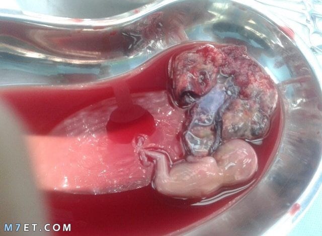الحمل خارج تجويف الرحم