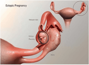 أعراض الحمل خارج تجويف الرحم ومعلومات أخرى هامة 3625056 231779729 صورة رقم 2