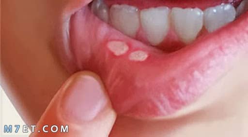 علاج حبوب الفم بعد السخونه أسبابها وطرق تفاديها وأفضل العلاجات لها