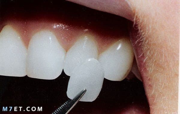 ما هو لومينير الأسنان ؟...وما ميزاته وأسباب تركبيه اللومينير والفينير صورة رقم 1