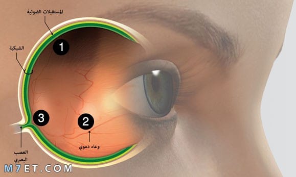 ما أسباب التهاب عصب العين