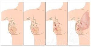 أسباب واعراض سرطان الثدي الحميد وعلاجه سرطان الثدى صورة رقم 2