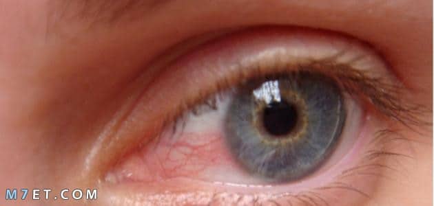ما أسباب التهاب عصب العين