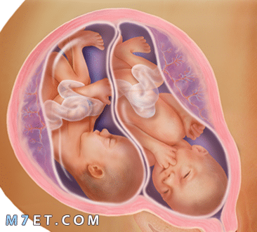 علاج نزول الجنين في الحوض