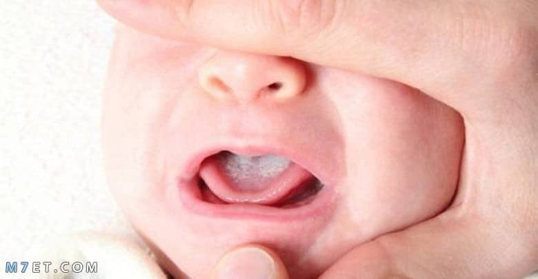 ما هو أفضل علاج للحمو بالبيت مجرب فطريات الفم عند الرضع بالاعشاب 1 صورة رقم 3