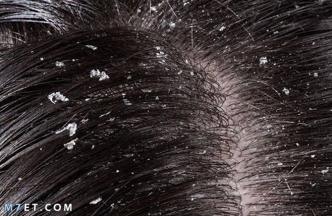 أسباب قشور الشعر وطرق علاجها