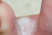 Photo of أسباب وعلاج الفطريات بين أصابع القدم..هكذا تتخلص منها