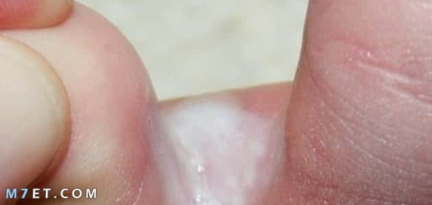 أسباب وعلاج الفطريات بين أصابع القدم..هكذا تتخلص منها الفطريات بين أصابع القدمين صورة رقم 1