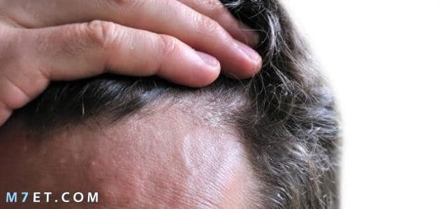 أفضل طرق علاج فطريات الرأس الفطريات في الشعر صورة رقم 1
