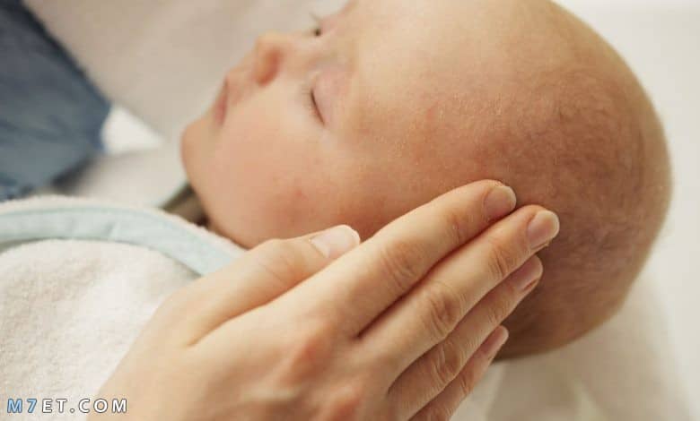 علاج قشرة الراس عند الاطفال