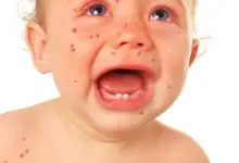 Photo of علاج الحصبة عند الاطفال