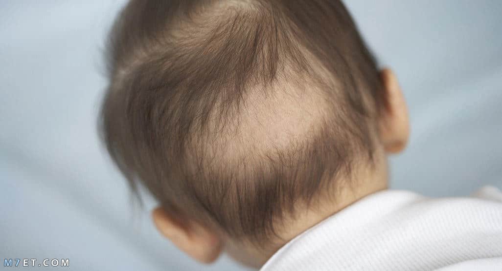 تساقط الشعر عند الاطفال