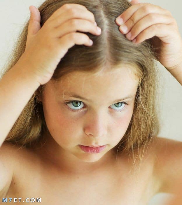 تساقط الشعر عند الاطفال