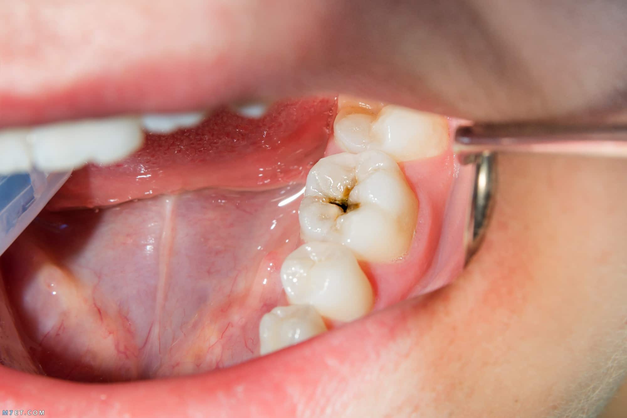 علاج تسوس اسنان الاطفال