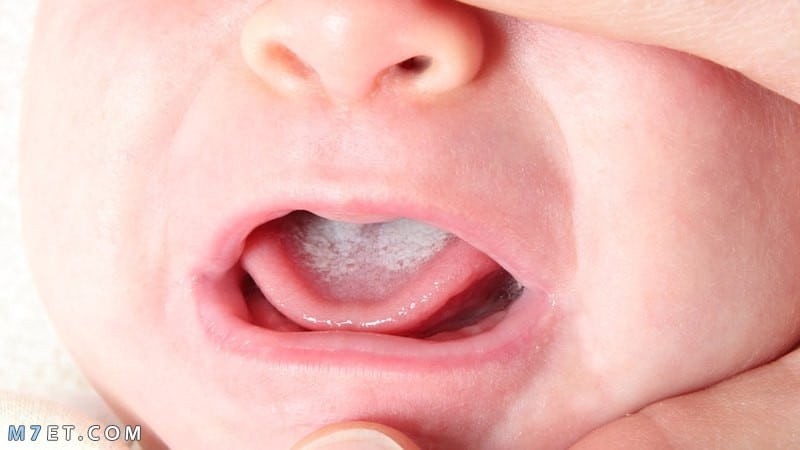  فطريات الفم عند الاطفال