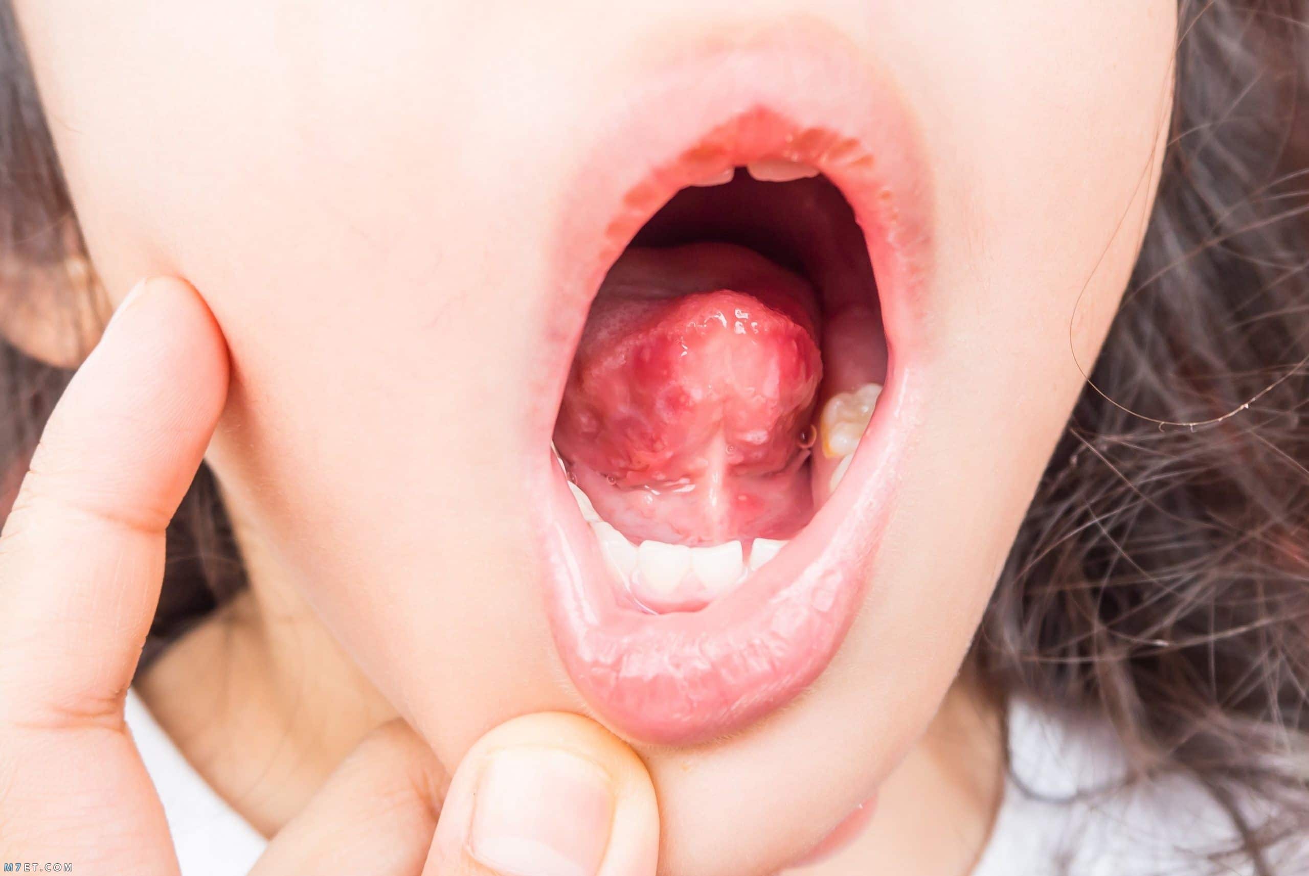  فطريات الفم عند الاطفال