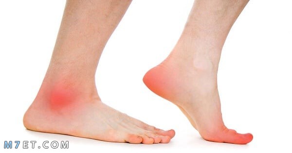 اعراض جلطة القدم