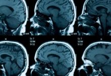 Photo of اعراض ضمور المخ وطرق علاج هذا المرض المجربة