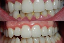 Photo of طرق علاج التهاب اللثة والأسنان وأهم 5 نصائح طبية للوقاية