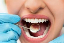Photo of كيف تتخلص من تسوس الأسنان في خمس خطوات