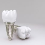 مراحل زراعة الأسنان هل هي بسيطة أم غير ذلك؟