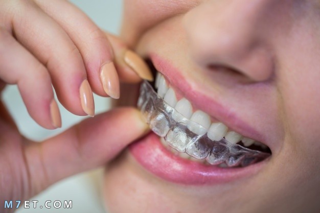 مراحل تقويم الأسنان