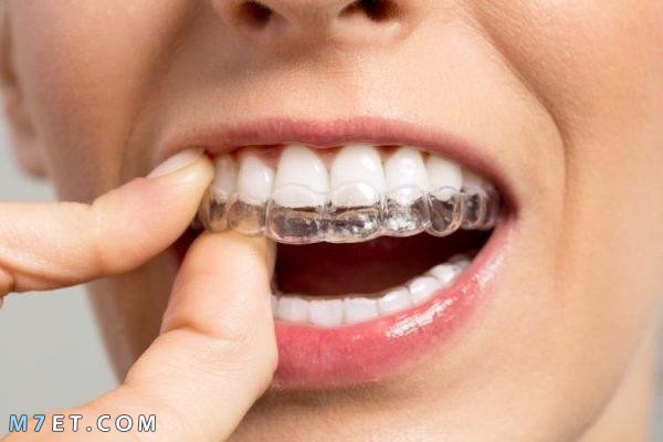 فوائد تقويم الاسنان