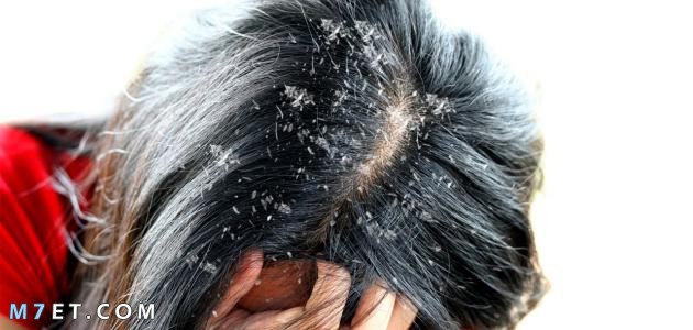 القس للإتصال شاطئ بحر  علاج قشرة الشعر الدهني بالوصفات المنزلية - موقع مُحيط