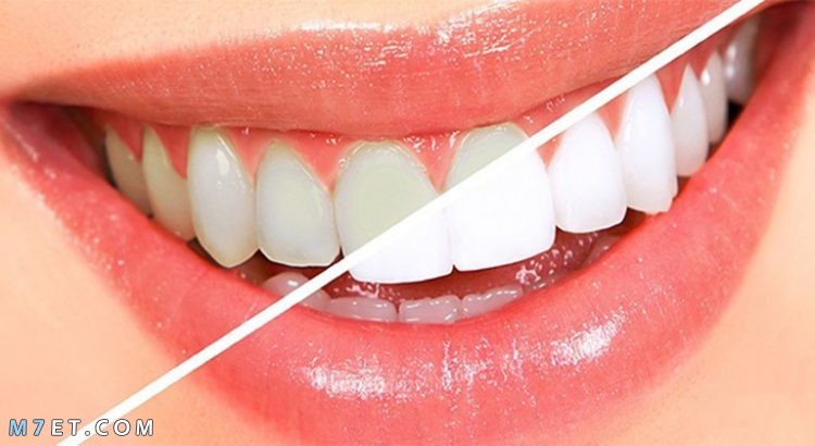 فوائد الخل للأسنان