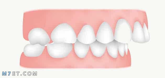 اسباب بروز الاسنان