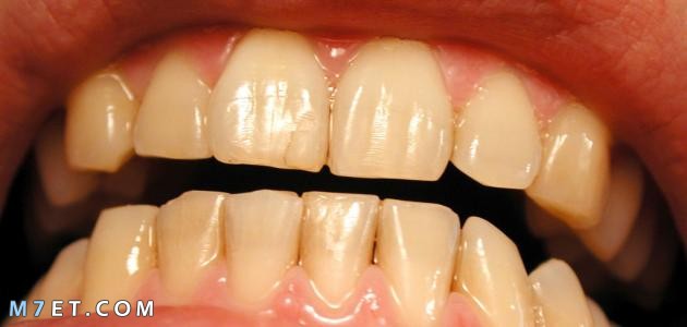 ما سبب اصفرار الأسنان