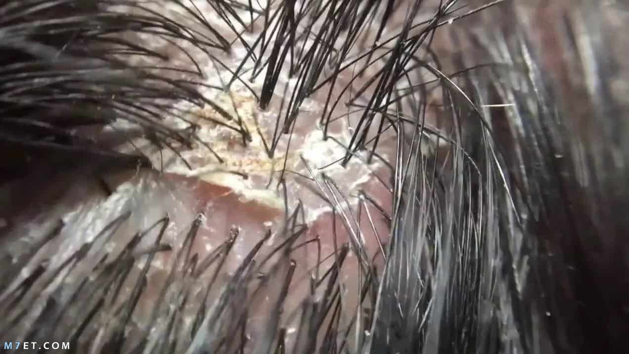انواع قشرة الشعر