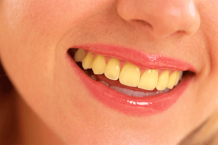 ما سبب اصفرار الأسنان