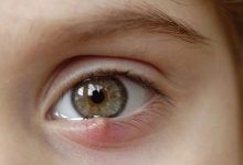 Photo of أسباب الحبوب الدهنية تحت العين وطرق العلاج بـ 5 أعشاب