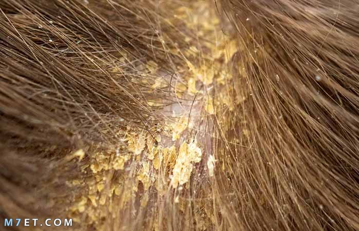 انواع قشرة الشعر