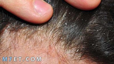 Photo of انواع قشرة الشعر وطرق العلاج بـ 3 أعشاب طبيعية