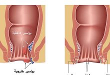 Photo of أسباب التهاب الناسور وأعراضه وطرق علاجه بالتفصيل