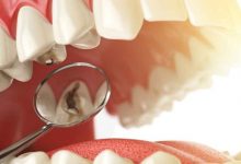 Photo of إزالة تسوس الاسنان| 11 طريقة للتخلص من التسوس نهائيا