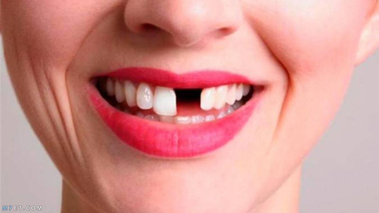 اسباب سقوط الاسنان