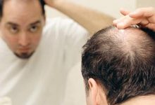 Photo of علاج تساقط الشعر للرجال واشهر 3 أدوية وشامبو لوقف التساقط