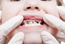Photo of أسباب تسوس الأسنان عند الكبار وطرق العلاج بالملح والقرنفل