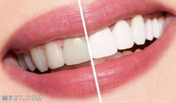 فوائد وأضرار تبييض الأسنان بالليزر لأسنان مثل اللؤلؤ