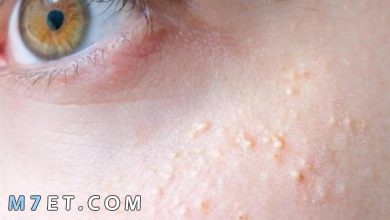 Photo of علاج الحبوب تحت الجلد في الوجه