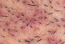 Photo of علاج نمو الشعر تحت الجلد بـ 3 أعشاب طبيعية