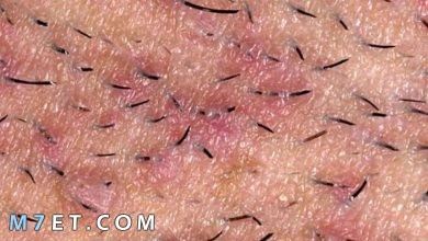 Photo of علاج نمو الشعر تحت الجلد بـ 3 أعشاب طبيعية